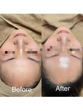 エー(A)/ジュエリーピール☆