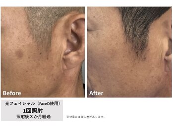 メイ(meiy)/しみ/美白/毛穴/フェイシャル