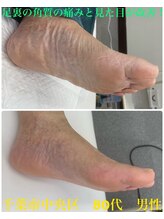 巻き爪じゅん 船橋店/角質による痛みも見た目も改善