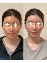 小顔22 ボルティ 赤坂支店(Bolty)/顔の心臓部【中顔面を変える】