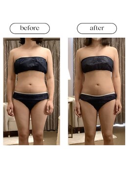 スラン(Slan)/ビフォーアフター/3ヶ月