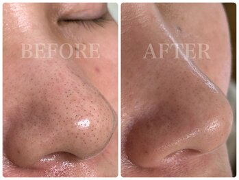 シェミー(CHEZ MEE)/頑固な毛穴汚れには毛穴洗浄◎