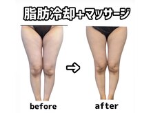 シャルム(CHARME)/脂肪冷却