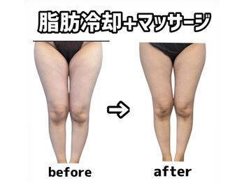 シャルム(CHARME)/脂肪冷却