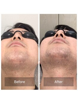 マリーローラン メンズルイズ(Marryrolan MensRuise)/メンズ脱毛【ヒゲ脱毛】