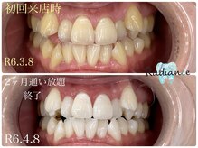 札幌セルフホワイトニング ラディアンス(Radiance)/2ヶ月通い放題Before→after