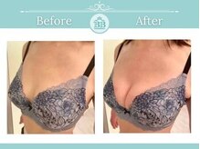 美人バスト 宇都宮店/★バストアップ症例/育乳★