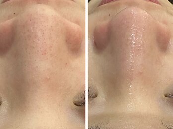 ケアナ 梅田店(CareNa)/ツヤ肌毛穴洗浄★ヒト由来幹細胞