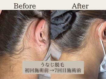 インベスト(INVEST)/うなじ脱毛