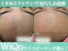 Cスキンケアクリニック 麻布店/WiQoピーリングビフォーアフター