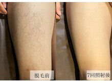 メンズアルファ/【脚】光脱毛before after 30代