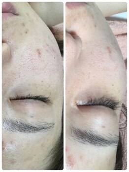 メイユール(MEILLEUR)/光フェイシャル