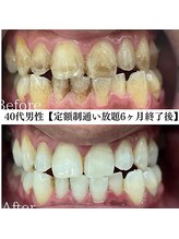 ホワイト 福岡博多店(WHITE)/ホワイトニングビフォーアフター