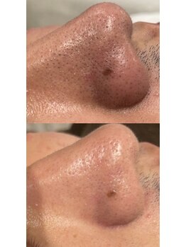 ビーメイクス(B・Makes)/ハイドラ洗浄