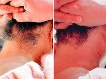 レネットサロン(Reinette Salon)/うなじ（Mパーツ）トリプル脱毛