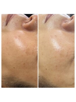 シャラ(shara)/ハリ、くすみ、小じわ、シミ改善