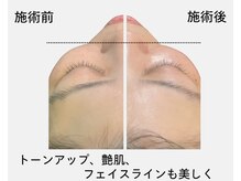 アイリー(iley)/ビフォーアフター