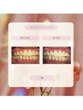 プラスビー 2号店(+b)/ホワイトニングビフォーアフター