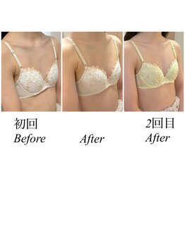 エレナ 伊勢崎(Ele'na)/バストケア1回施術前後