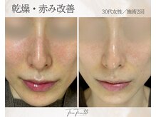スリースリー 恵比寿(THREE THREE)/乾燥・赤みケア