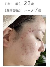 ノーブル 新宿南口(NOBLE)/ハーブピーリング専門新宿