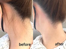 アイブロウサロン アヴィ(A‘VI)/ うなじ襟足　光×ワックス脱毛