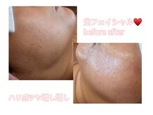 アルーア(Allure)/光フェイシャル♪