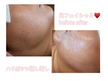 アルーア(Allure)/光フェイシャル♪