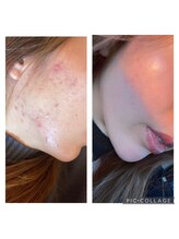 アリュール 京都烏丸御池店(ALLURE)/ハーブピーリング　#ニキビケア