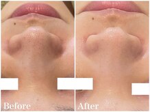 サロンドフェイス(Salon de Faith)/【ハーブピーリング】1回施術♪