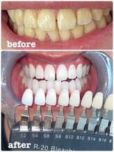エクシア ホワイトニング 富山店/ビフォーアフター写真☆