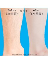ブロッサム(BLOSSOM)/ひざ下の脱毛
