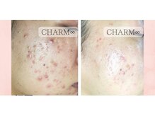 チャームプラス(CHARM+)/【ハーブピーリング】
