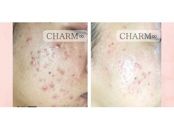 チャームプラス(CHARM+)/【ハーブピーリング】