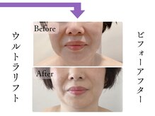 クローネ(Krone)/ウルトラリフトビフォーアフター