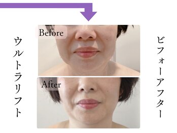 クローネ(Krone)/ウルトラリフトビフォーアフター