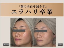 オーク ナチュリ 成城学園前(OAK×NACHUL)/ダウンタイムのない最新施術