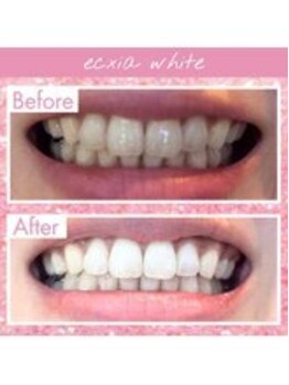 エクシアホワイトニング 長崎店/ホワイトニングビフォーアフター