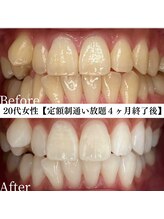 ホワイト 福岡博多店(WHITE)/ホワイトニングビフォーアフター