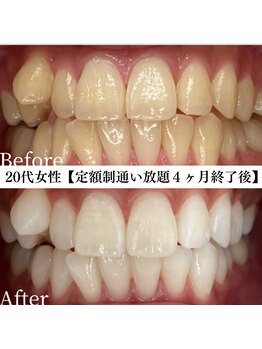 ホワイト 福岡博多店(WHITE)/ホワイトニングビフォーアフター