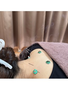 スマイルなごみ鍼灸整骨院の写真/年齢を重ねるごとに気になるお悩みに◎身体の内側から綺麗になれる美容法★美容鍼ですっきり小顔をGET！