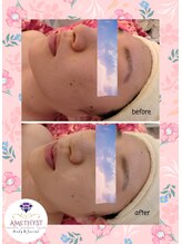 プライベートエステティックサロン アメジスト(AMETHYST)/水光ジェット★before　after★