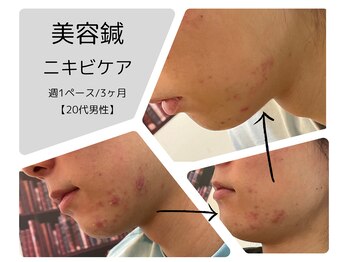 東合川はりきゅう整骨院/美容鍼／ニキビケア