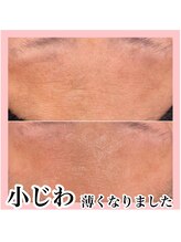 エクラーレ(Eclale)/ハーブピーリング症例