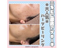ホワイトアクア 岐阜店(WHITE AQUA)/ハーブピーリング/岐阜/毛穴