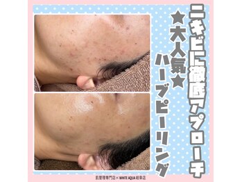 ホワイトアクア 岐阜店(WHITE AQUA)/ハーブピーリング/岐阜/毛穴