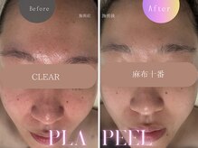 クリア 麻布十番(CLEAR)/プラピール　ビフォーアフター