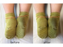 ハレノヒ(HARENOHI)/【施術後の検査】