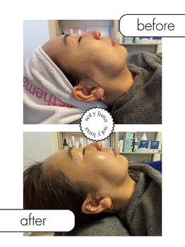 お肌の土台から整える sol y luna 麻布十番店【肌質改善/エイジングケア】/リフトアップピーリング