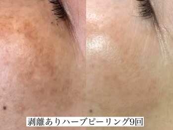 アリス(ALICE)/シミ、くすみにハーブピーリング